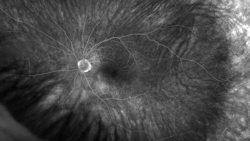 PEHCR - Peripheral Exudative Hemorrhagic Chorioretinopathy
