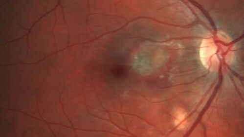 Punctate Inner Choroidopathy and Choroidal Neovascular Membrane (CNVM)
24 year old female She was doing fine until 4 days ago when the right eye fogged up on her.Â  The left eye is seeing fine.Â  In the end of January (3 months ago) she went to the doctor and got checked for everything and it was negative.Â  She had a bad cough at the time and no fevers that she knows of.Â Â 
VA OD: sc20/200+1, VA OS: sc20/25 - Uveitis work up was negative.  VA improved to 20/40 with a single avastin treatment and then the patient was lost to follow-up

