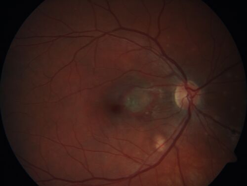 Punctate Inner Choroidopathy and Choroidal Neovascular Membrane (CNVM)
24 year old female She was doing fine until 4 days ago when the right eye fogged up on her.Â  The left eye is seeing fine.Â  In the end of January (3 months ago) she went to the doctor and got checked for everything and it was negative.Â  She had a bad cough at the time and no fevers that she knows of.Â Â 
VA OD: sc20/200+1, VA OS: sc20/25 - Uveitis work up was negative.  VA improved to 20/40 with a single avastin treatment and then the patient was lost to follow-up
