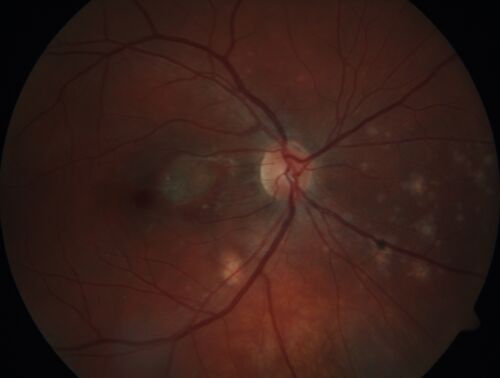 Punctate Inner Choroidopathy and Choroidal Neovascular Membrane (CNVM)
24 year old female She was doing fine until 4 days ago when the right eye fogged up on her.Â  The left eye is seeing fine.Â  In the end of January (3 months ago) she went to the doctor and got checked for everything and it was negative.Â  She had a bad cough at the time and no fevers that she knows of.Â Â 
VA OD: sc20/200+1, VA OS: sc20/25 - Uveitis work up was negative.  VA improved to 20/40 with a single avastin treatment and then the patient was lost to follow-up
