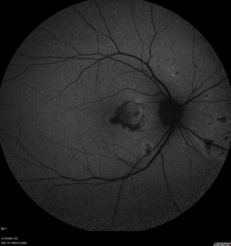 Punctate inner choroidopathy and CNVM
23 year old female noticed vision loss for 4 days.
VA 20/200 OD, 20/25 OS.
VA improved one month later to 20/40 with Avastin.  She received a second injection and was lost to follow-up
