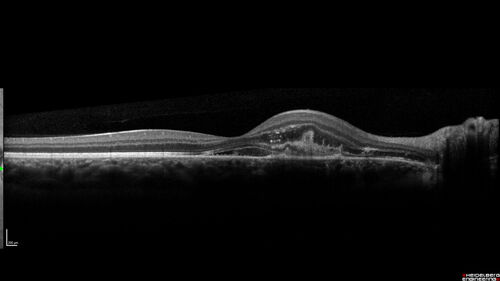 Punctate Inner Choroidopathy and Choroidal Neovascular Membrane (CNVM)
24 year old female She was doing fine until 4 days ago when the right eye fogged up on her.Â  The left eye is seeing fine.Â  In the end of January (3 months ago) she went to the doctor and got checked for everything and it was negative.Â  She had a bad cough at the time and no fevers that she knows of.Â Â 
VA OD: sc20/200+1, VA OS: sc20/25 - Uveitis work up was negative.  VA improved to 20/40 with a single avastin treatment and then the patient was lost to follow-up
