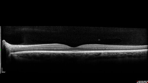 Punctate Inner Choroidopathy and Choroidal Neovascular Membrane (CNVM)
24 year old female She was doing fine until 4 days ago when the right eye fogged up on her.Â  The left eye is seeing fine.Â  In the end of January (3 months ago) she went to the doctor and got checked for everything and it was negative.Â  She had a bad cough at the time and no fevers that she knows of.Â Â 
VA OD: sc20/200+1, VA OS: sc20/25 - Uveitis work up was negative.  VA improved to 20/40 with a single avastin treatment and then the patient was lost to follow-up
