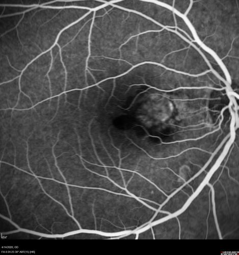 Punctate Inner Choroidopathy and Choroidal Neovascular Membrane (CNVM)
24 year old female She was doing fine until 4 days ago when the right eye fogged up on her.Â  The left eye is seeing fine.Â  In the end of January (3 months ago) she went to the doctor and got checked for everything and it was negative.Â  She had a bad cough at the time and no fevers that she knows of.Â Â 
VA OD: sc20/200+1, VA OS: sc20/25 - Uveitis work up was negative.  VA improved to 20/40 with a single avastin treatment and then the patient was lost to follow-up
