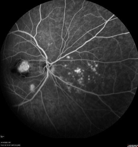 Punctate inner choroidopathy and CNVM
23 year old female noticed vision loss for 4 days.
VA 20/200 OD, 20/25 OS.
VA improved one month later to 20/40 with Avastin.  She received a second injection and was lost to follow-up
