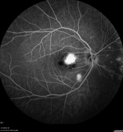 Punctate Inner Choroidopathy and Choroidal Neovascular Membrane (CNVM)
24 year old female She was doing fine until 4 days ago when the right eye fogged up on her.Â  The left eye is seeing fine.Â  In the end of January (3 months ago) she went to the doctor and got checked for everything and it was negative.Â  She had a bad cough at the time and no fevers that she knows of.Â Â 
VA OD: sc20/200+1, VA OS: sc20/25 - Uveitis work up was negative.  VA improved to 20/40 with a single avastin treatment and then the patient was lost to follow-up
