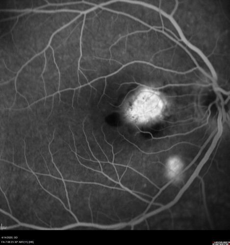 Punctate Inner Choroidopathy and Choroidal Neovascular Membrane (CNVM)
24 year old female She was doing fine until 4 days ago when the right eye fogged up on her.Â  The left eye is seeing fine.Â  In the end of January (3 months ago) she went to the doctor and got checked for everything and it was negative.Â  She had a bad cough at the time and no fevers that she knows of.Â Â 
VA OD: sc20/200+1, VA OS: sc20/25 - Uveitis work up was negative.  VA improved to 20/40 with a single avastin treatment and then the patient was lost to follow-up
