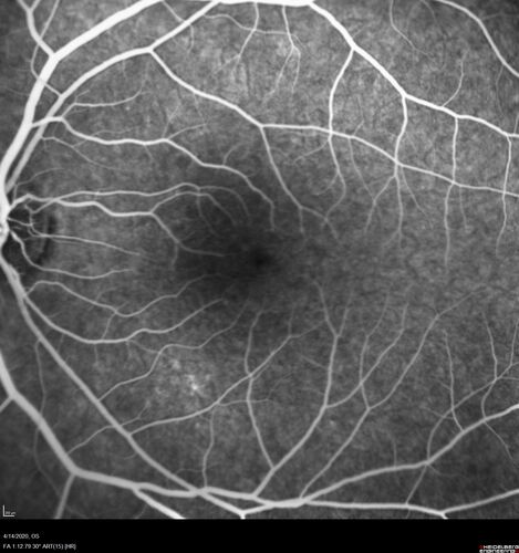 Punctate Inner Choroidopathy and Choroidal Neovascular Membrane (CNVM)
24 year old female She was doing fine until 4 days ago when the right eye fogged up on her.Â  The left eye is seeing fine.Â  In the end of January (3 months ago) she went to the doctor and got checked for everything and it was negative.Â  She had a bad cough at the time and no fevers that she knows of.Â Â 
VA OD: sc20/200+1, VA OS: sc20/25 - Uveitis work up was negative.  VA improved to 20/40 with a single avastin treatment and then the patient was lost to follow-up
