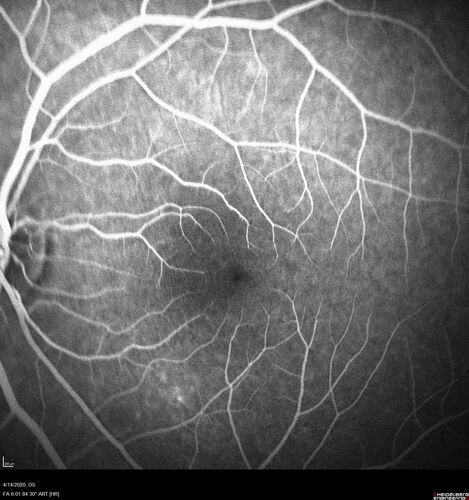Punctate inner choroidopathy and CNVM
23 year old female noticed vision loss for 4 days.
VA 20/200 OD, 20/25 OS.
VA improved one month later to 20/40 with Avastin.  She received a second injection and was lost to follow-up
