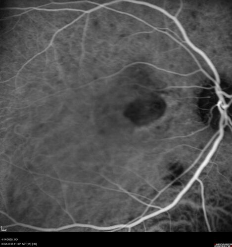 Punctate Inner Choroidopathy and Choroidal Neovascular Membrane (CNVM)
24 year old female She was doing fine until 4 days ago when the right eye fogged up on her.Â  The left eye is seeing fine.Â  In the end of January (3 months ago) she went to the doctor and got checked for everything and it was negative.Â  She had a bad cough at the time and no fevers that she knows of.Â Â 
VA OD: sc20/200+1, VA OS: sc20/25 - Uveitis work up was negative.  VA improved to 20/40 with a single avastin treatment and then the patient was lost to follow-up
