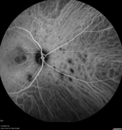 Punctate Inner Choroidopathy and Choroidal Neovascular Membrane (CNVM)
24 year old female She was doing fine until 4 days ago when the right eye fogged up on her.Â  The left eye is seeing fine.Â  In the end of January (3 months ago) she went to the doctor and got checked for everything and it was negative.Â  She had a bad cough at the time and no fevers that she knows of.Â Â 
VA OD: sc20/200+1, VA OS: sc20/25 - Uveitis work up was negative.  VA improved to 20/40 with a single avastin treatment and then the patient was lost to follow-up
