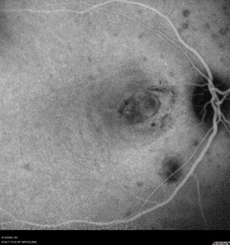 Punctate inner choroidopathy and CNVM
23 year old female noticed vision loss for 4 days.
VA 20/200 OD, 20/25 OS.
VA improved one month later to 20/40 with Avastin.  She received a second injection and was lost to follow-up
