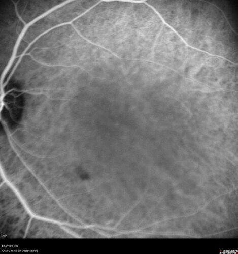 Punctate Inner Choroidopathy and Choroidal Neovascular Membrane (CNVM)
24 year old female She was doing fine until 4 days ago when the right eye fogged up on her.Â  The left eye is seeing fine.Â  In the end of January (3 months ago) she went to the doctor and got checked for everything and it was negative.Â  She had a bad cough at the time and no fevers that she knows of.Â Â 
VA OD: sc20/200+1, VA OS: sc20/25 - Uveitis work up was negative.  VA improved to 20/40 with a single avastin treatment and then the patient was lost to follow-up
