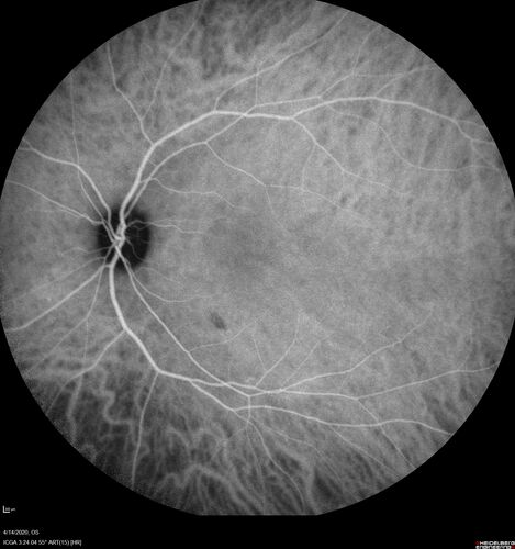Punctate inner choroidopathy and CNVM
23 year old female noticed vision loss for 4 days.
VA 20/200 OD, 20/25 OS.
VA improved one month later to 20/40 with Avastin.  She received a second injection and was lost to follow-up
