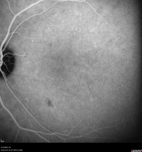 Punctate inner choroidopathy and CNVM
23 year old female noticed vision loss for 4 days.
VA 20/200 OD, 20/25 OS.
VA improved one month later to 20/40 with Avastin.  She received a second injection and was lost to follow-up
