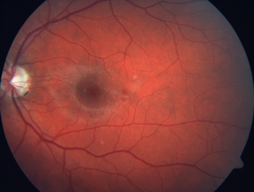 Punctate Inner Choroidopathy (PIC) Mild
24 year old female with high myopia.  Noticing some distortion on grid.  Vision 20/20 OU.  Was followed frequently for several months with no progression and no CNVM.
