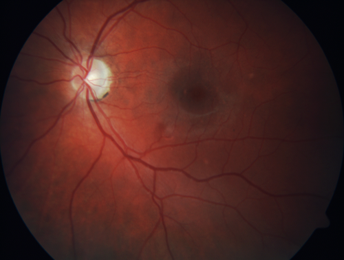 Punctate Inner Choroidopathy (PIC) Mild
24 year old female with high myopia.  Noticing some distortion on grid.  Vision 20/20 OU.  Was followed frequently for several months with no progression and no CNVM.
