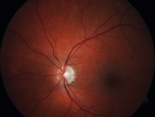 Punctate Inner Choroidopathy (PIC) Mild
24 year old female with high myopia.  Noticing some distortion on grid.  Vision 20/20 OU.  Was followed frequently for several months with no progression and no CNVM.
