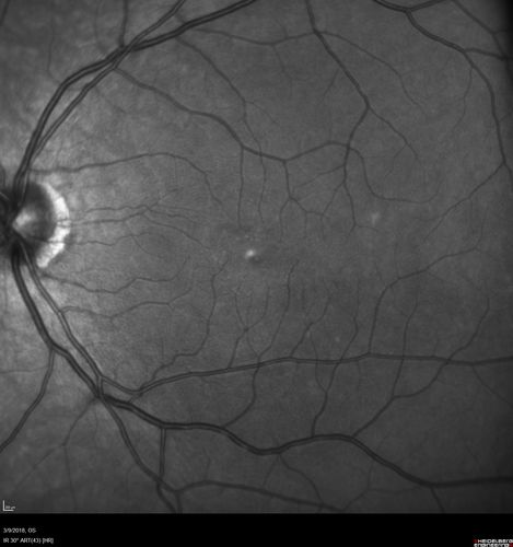 Punctate Inner Choroidopathy (PIC) Mild
24 year old female with high myopia.  Noticing some distortion on grid.  Vision 20/20 OU.  Was followed frequently for several months with no progression and no CNVM.
