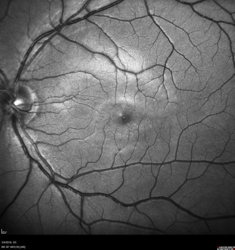 Punctate Inner Choroidopathy (PIC) Mild
24 year old female with high myopia.  Noticing some distortion on grid.  Vision 20/20 OU.  Was followed frequently for several months with no progression and no CNVM.
