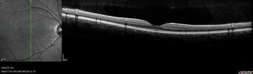 Punctate Inner Choroidopathy (PIC) Mild
24 year old female with high myopia.  Noticing some distortion on grid.  Vision 20/20 OU.  Was followed frequently for several months with no progression and no CNVM.
