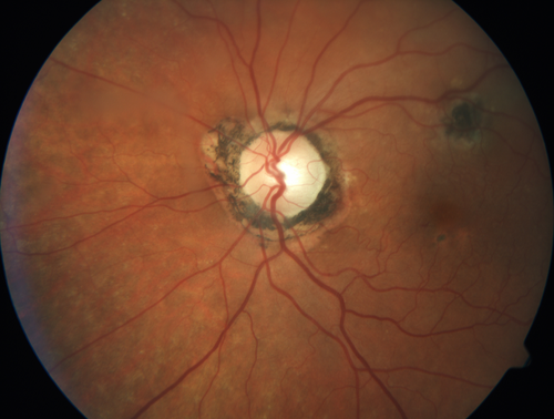 Macular Scars from Presumed Ocular Histoplasmosis Syndrome
85 year old man 
He sometimes sees double vision.  When he sees people walking they are sometimes double for about 6 months.  
VA OD: sc20/25 PH20/20 NccJ3
VA OS: sc20/20-2 NccJ2
IOP: TP: OD:12 OS:14
