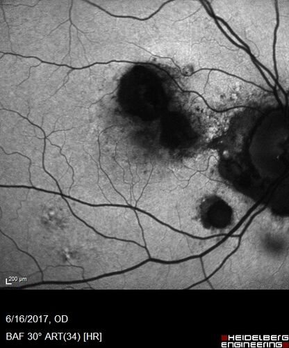 Macular Scars from Presumed Ocular Histoplasmosis Syndrome
85 year old man 
He sometimes sees double vision.  When he sees people walking they are sometimes double for about 6 months.  
VA OD: sc20/25 PH20/20 NccJ3
VA OS: sc20/20-2 NccJ2
IOP: TP: OD:12 OS:14
