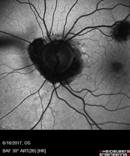 Macular Scars from Presumed Ocular Histoplasmosis Syndrome
85 year old man 
He sometimes sees double vision.  When he sees people walking they are sometimes double for about 6 months.  
VA OD: sc20/25 PH20/20 NccJ3
VA OS: sc20/20-2 NccJ2
IOP: TP: OD:12 OS:14
