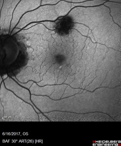 Macular Scars from Presumed Ocular Histoplasmosis Syndrome
85 year old man 
He sometimes sees double vision.  When he sees people walking they are sometimes double for about 6 months.  
VA OD: sc20/25 PH20/20 NccJ3
VA OS: sc20/20-2 NccJ2
IOP: TP: OD:12 OS:14
