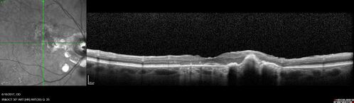 Macular Scars from Presumed Ocular Histoplasmosis Syndrome
85 year old man 
He sometimes sees double vision.  When he sees people walking they are sometimes double for about 6 months.  
VA OD: sc20/25 PH20/20 NccJ3
VA OS: sc20/20-2 NccJ2
IOP: TP: OD:12 OS:14
