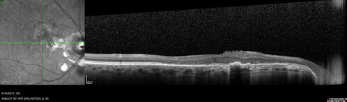 Macular Scars from Presumed Ocular Histoplasmosis Syndrome
85 year old man 
He sometimes sees double vision.  When he sees people walking they are sometimes double for about 6 months.  
VA OD: sc20/25 PH20/20 NccJ3
VA OS: sc20/20-2 NccJ2
IOP: TP: OD:12 OS:14
