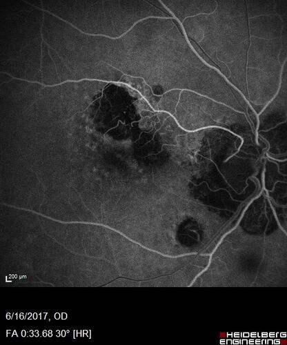 Macular Scars from Presumed Ocular Histoplasmosis Syndrome
85 year old man 
He sometimes sees double vision.  When he sees people walking they are sometimes double for about 6 months.  
VA OD: sc20/25 PH20/20 NccJ3
VA OS: sc20/20-2 NccJ2
IOP: TP: OD:12 OS:14
