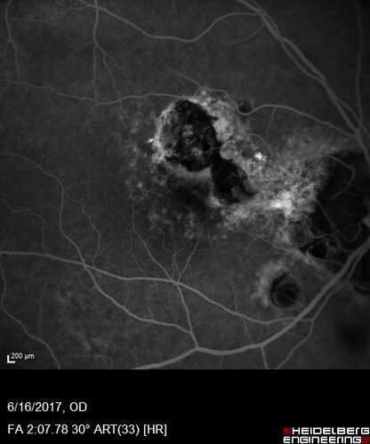 Macular Scars from Presumed Ocular Histoplasmosis Syndrome
85 year old man 
He sometimes sees double vision.  When he sees people walking they are sometimes double for about 6 months.  
VA OD: sc20/25 PH20/20 NccJ3
VA OS: sc20/20-2 NccJ2
IOP: TP: OD:12 OS:14
