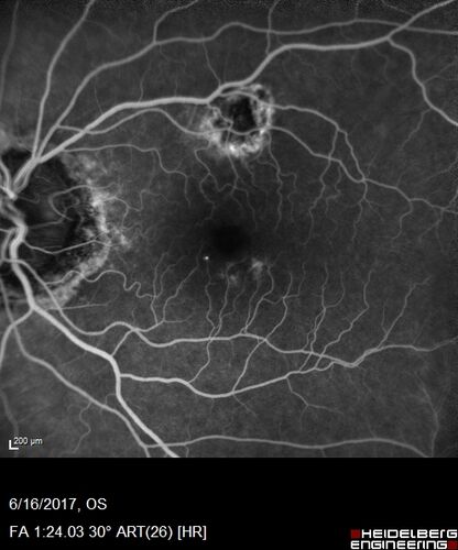 Macular Scars from Presumed Ocular Histoplasmosis Syndrome
85 year old man 
He sometimes sees double vision.  When he sees people walking they are sometimes double for about 6 months.  
VA OD: sc20/25 PH20/20 NccJ3
VA OS: sc20/20-2 NccJ2
IOP: TP: OD:12 OS:14

