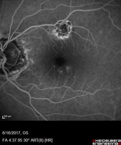 Macular Scars from Presumed Ocular Histoplasmosis Syndrome
85 year old man 
He sometimes sees double vision.  When he sees people walking they are sometimes double for about 6 months.  
VA OD: sc20/25 PH20/20 NccJ3
VA OS: sc20/20-2 NccJ2
IOP: TP: OD:12 OS:14

