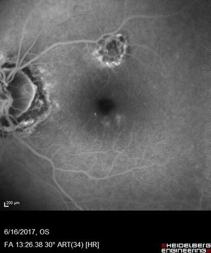 Macular Scars from Presumed Ocular Histoplasmosis Syndrome
85 year old man 
He sometimes sees double vision.  When he sees people walking they are sometimes double for about 6 months.  
VA OD: sc20/25 PH20/20 NccJ3
VA OS: sc20/20-2 NccJ2
IOP: TP: OD:12 OS:14
