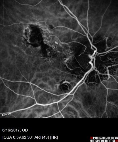 Macular Scars from Presumed Ocular Histoplasmosis Syndrome
85 year old man 
He sometimes sees double vision.  When he sees people walking they are sometimes double for about 6 months.  
VA OD: sc20/25 PH20/20 NccJ3
VA OS: sc20/20-2 NccJ2
IOP: TP: OD:12 OS:14
