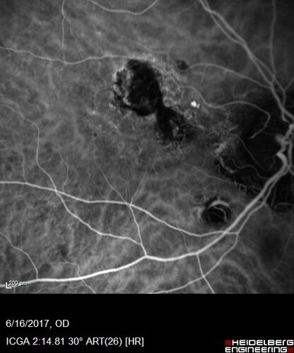 Macular Scars from Presumed Ocular Histoplasmosis Syndrome
85 year old man 
He sometimes sees double vision.  When he sees people walking they are sometimes double for about 6 months.  
VA OD: sc20/25 PH20/20 NccJ3
VA OS: sc20/20-2 NccJ2
IOP: TP: OD:12 OS:14
