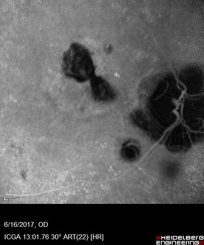 Macular Scars from Presumed Ocular Histoplasmosis Syndrome
85 year old man 
He sometimes sees double vision.  When he sees people walking they are sometimes double for about 6 months.  
VA OD: sc20/25 PH20/20 NccJ3
VA OS: sc20/20-2 NccJ2
IOP: TP: OD:12 OS:14
