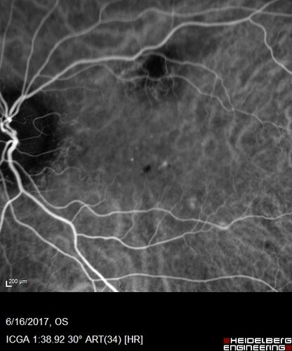 Macular Scars from Presumed Ocular Histoplasmosis Syndrome
85 year old man 
He sometimes sees double vision.  When he sees people walking they are sometimes double for about 6 months.  
VA OD: sc20/25 PH20/20 NccJ3
VA OS: sc20/20-2 NccJ2
IOP: TP: OD:12 OS:14
