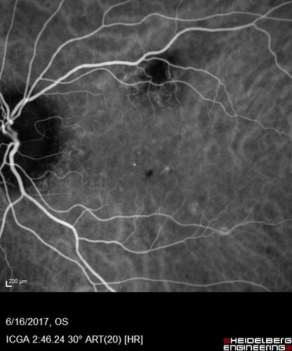 Macular Scars from Presumed Ocular Histoplasmosis Syndrome
85 year old man 
He sometimes sees double vision.  When he sees people walking they are sometimes double for about 6 months.  
VA OD: sc20/25 PH20/20 NccJ3
VA OS: sc20/20-2 NccJ2
IOP: TP: OD:12 OS:14
