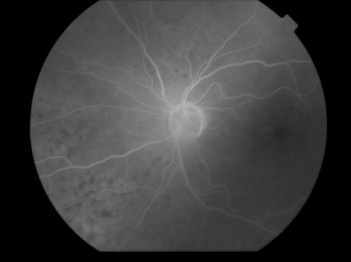 Uveitis and Retinal Whitening - 04-27-12 - Prior to PPV OD - Possible Primary Ocular Lymphoma 
