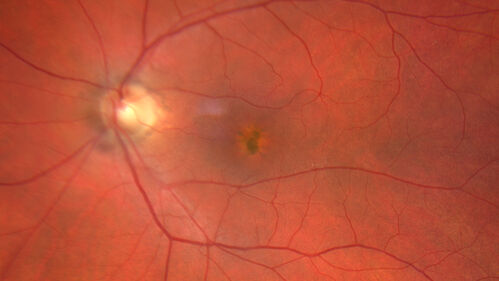 Pattern Dystrophy with Collapsed Vitelliform
74 year old female with vision loss in eye with collapsed vitelliform lesion.
