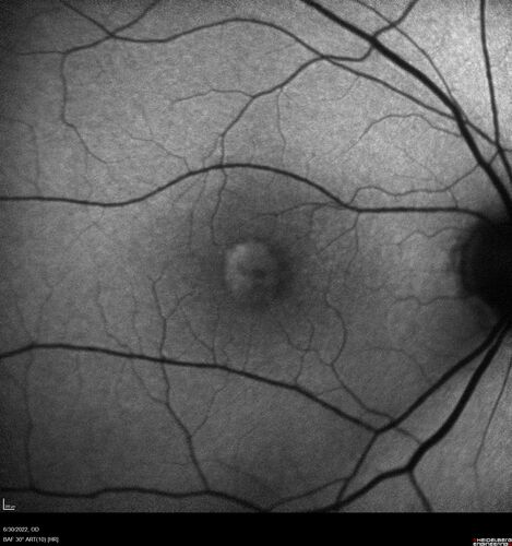 Pattern Dystrophy with Collapsed Vitelliform
74 year old female with vision loss in eye with collapsed vitelliform lesion.
