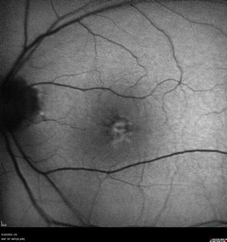 Pattern Dystrophy with Collapsed Vitelliform
74 year old female with vision loss in eye with collapsed vitelliform lesion.
