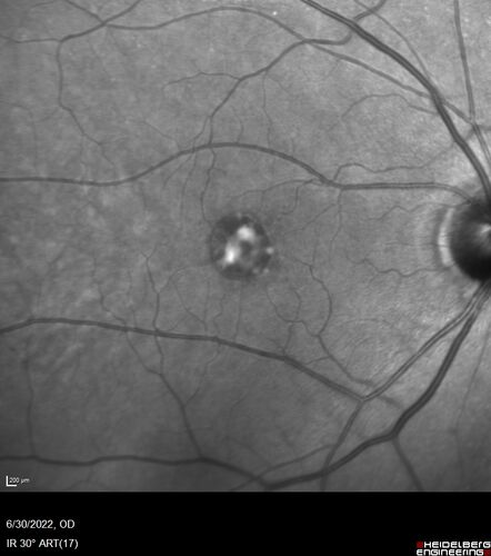 Pattern Dystrophy with Collapsed Vitelliform
74 year old female with vision loss in eye with collapsed vitelliform lesion.
