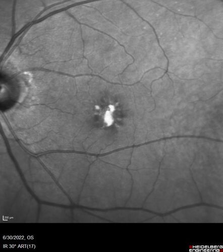 Pattern Dystrophy with Collapsed Vitelliform
74 year old female with vision loss in eye with collapsed vitelliform lesion.
