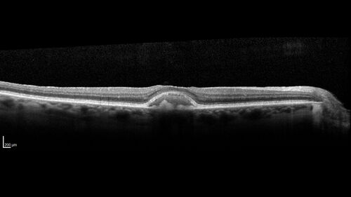 Pattern Dystrophy with Collapsed Vitelliform
74 year old female with vision loss in eye with collapsed vitelliform lesion.
