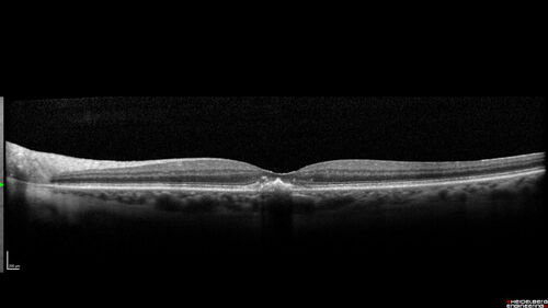 Pattern Dystrophy with Collapsed Vitelliform
74 year old female with vision loss in eye with collapsed vitelliform lesion.
