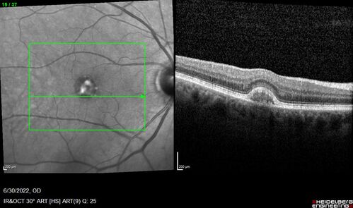 Pattern Dystrophy with Collapsed Vitelliform
74 year old female with vision loss in eye with collapsed vitelliform lesion.
